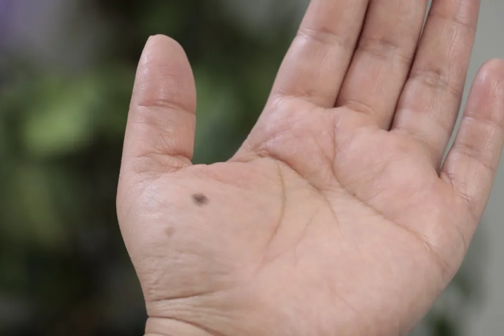 El ISSEMyM Recomienda tener Cuidado con lunares alterados en Manos y Pies pueden ser Cancerígenos