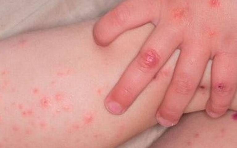 Exige PAN no minimizar el primer caso de sarampión en la CDMX