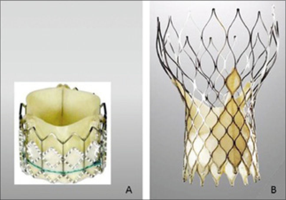 Medtronic lanza al mercado su última generación de válvula aórtica bicúspide para tratar la estenosis aórt ica