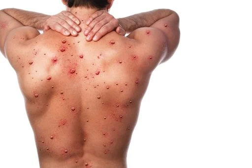 Aumentan contagios de Mpox en la CDMX